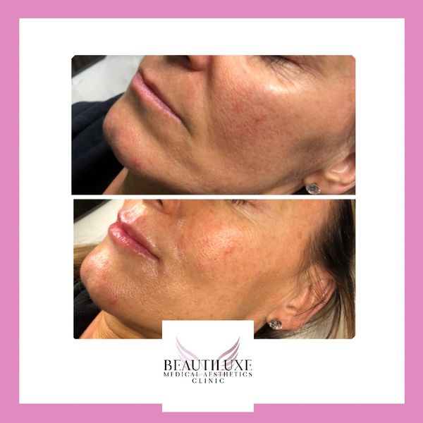 perioral filler treatments preston
thin lips filler
bamber bridge lip filler
preston lip filler