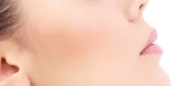 After apply Fillers Beauty photo