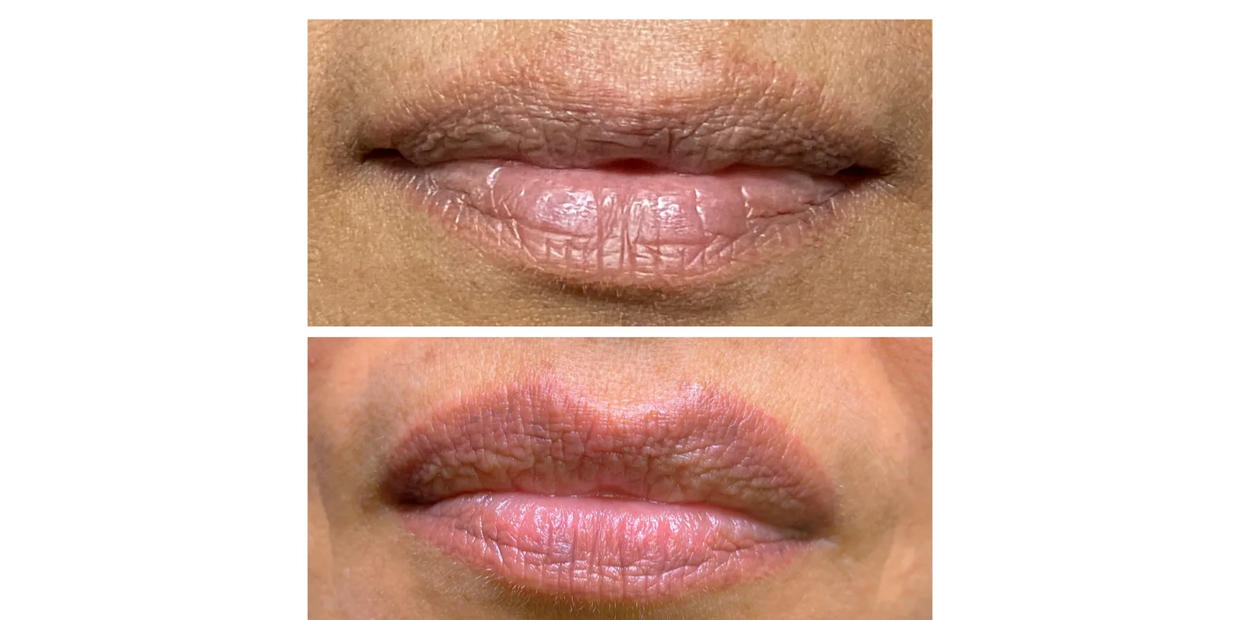 Unedited Before & After Photo of Lip Lightening done at Le Beau Visage