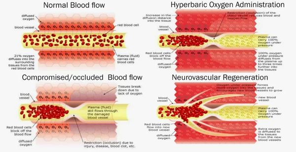 Diagram comparing normal, compromised, and hyperbaric oxygen blood flow and neurovascular regeneration.