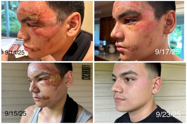 These photos were taken before and after a serious of 8 sessions 
