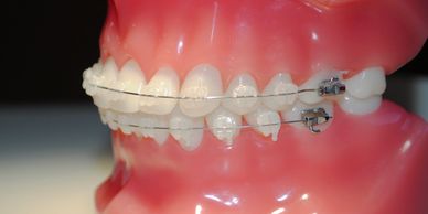 Keeping Your Clear Braces Clean - Perkins Dental Care Baltimore