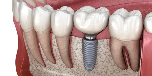 A diagram depicting a dental implant next to a tooth