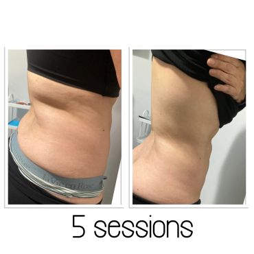 Before and after photos showing body transformation after 5 sessions.