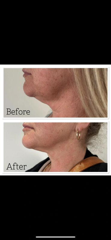Side-by-side before and after photos showing improved jawline and reduced double chin.