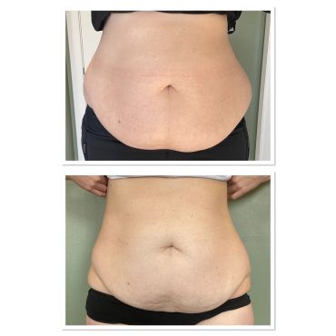 Before and after photos showing reduction in abdominal fat.