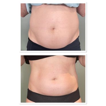 Before and after photos of a person's abdominal area showing fat reduction.