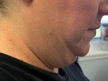 Close-up of a person's neck with visible skin texture and a double chin.