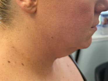 Close-up of a person's lower face and neck showing skin texture and moles.