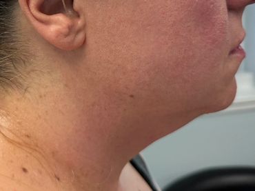 Close-up of a person's side profile showing skin texture and minor blemishes.