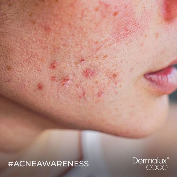 A face with acne lesions for acne awareness month