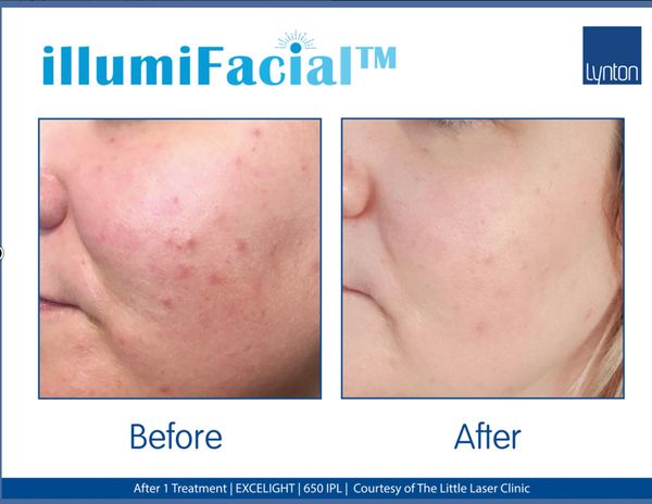 Results from IllumiFacial - reduced redness & Acne, improved skin tone and texture. 