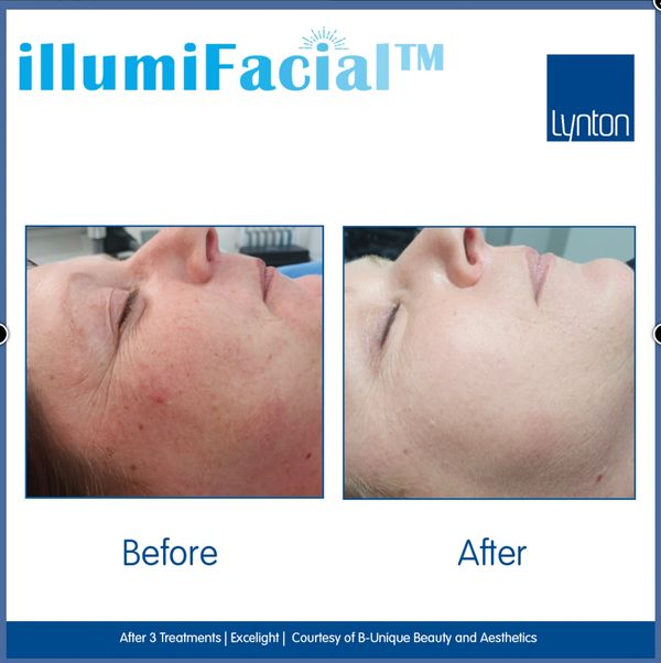 Results from IllumiFacial - reduced redness, improved crows feet.