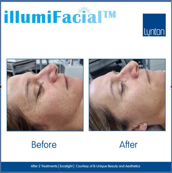 Results from IllumiFacial - reduced redness, improved crows feet. Improved skin tone and texture.