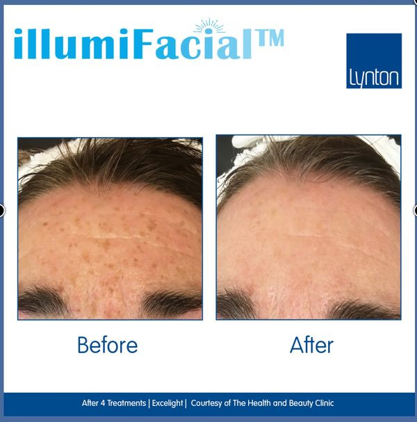 Results from IllumiFacial - reduced lines and wrinkles and significantly improved Pigmentation. 