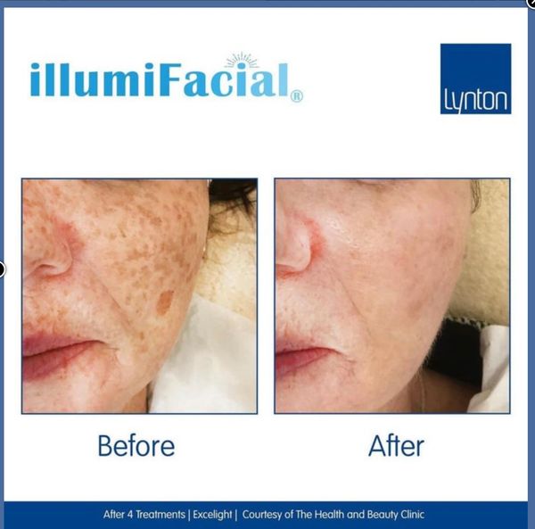 Results from IllumiFacial - reduced redness, improved lines, wrinkles and hyperpigmentation.