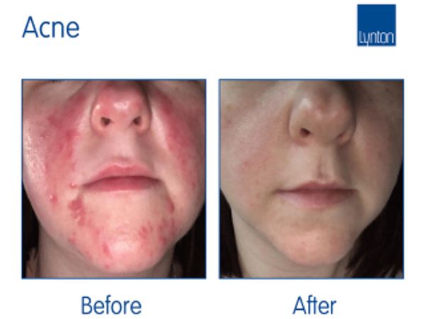 Before image of a face with acne and after image following IPL Acne treatment