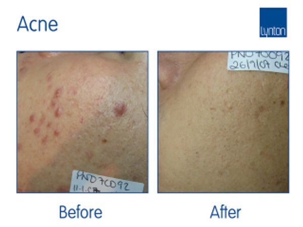 Before image of a face with active acne and image after treatment with IPL with reduced acne