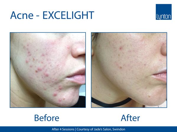 Before and after image of a face with acne lesions and the same face after treatment with IPL