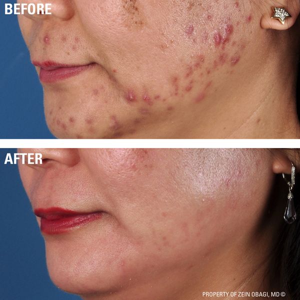 Lower face showing Acne before an after treatment with ZO skincare