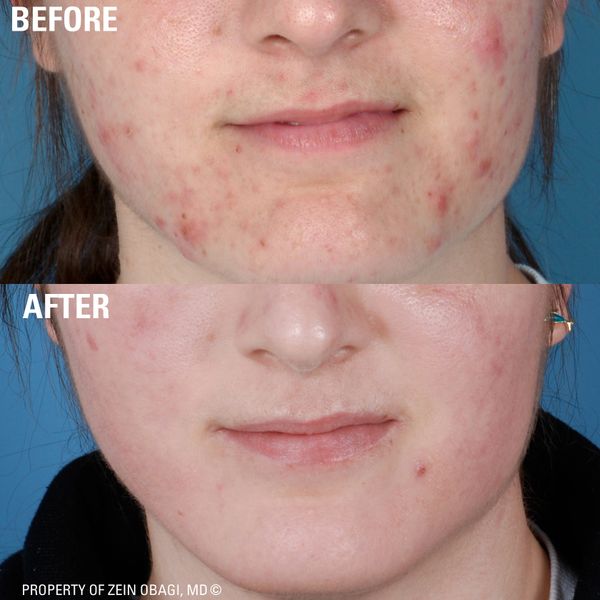 Before and after image of lower part of a female face which has been treated with ZO skin care