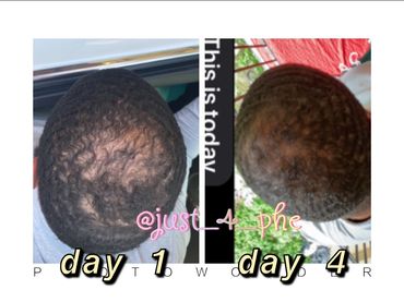 Male pattern baldness repair 