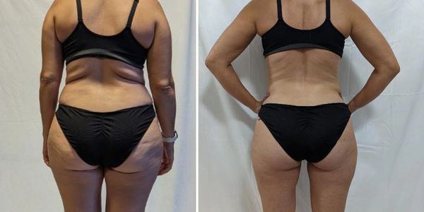 womans backside before and after showing weight loss