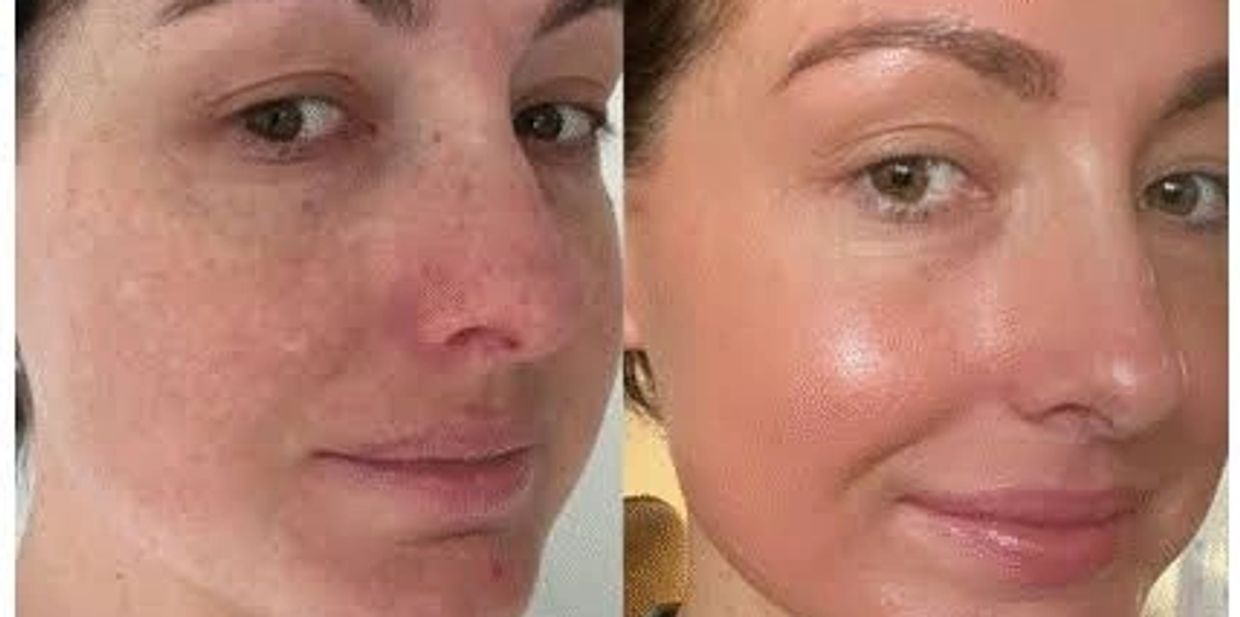 Cosmelan Peel Treatment