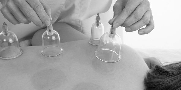 Hands placing vacuum cups on a person's back for cupping therapy.