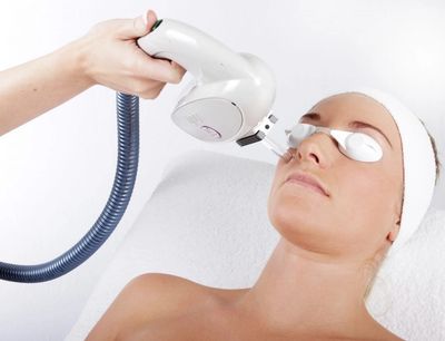 Rosacea IPL laser treatment on face