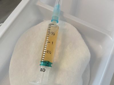 Syringe containing PRP (Platelet Rich Plasma)
