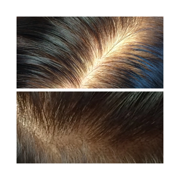 Women's thinning hair scalp micropigmentation creates the look of a fuller head of hair.