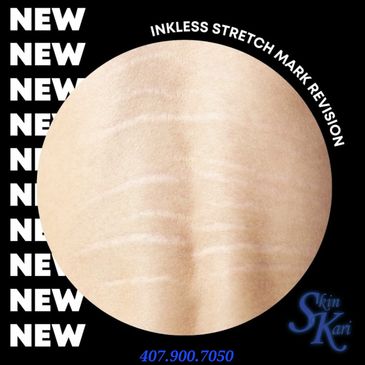 Inkless Stretch Mark Revision is a treatment that lightens  and flattens the stretch marks to dimini