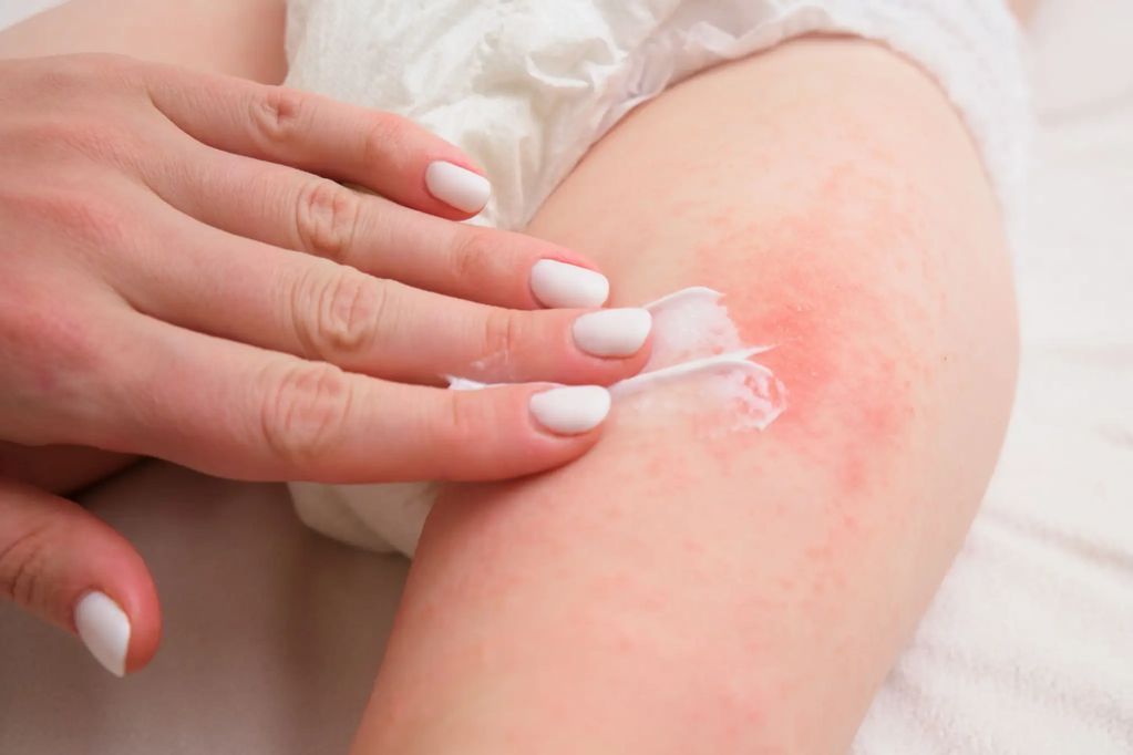 Radiation Skin Care

Radyoterapiye bağlı cilt bakımı

Radyoterapi sürecinde cilt bakımına yönelik de