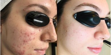 acne bootcamp acne treatment