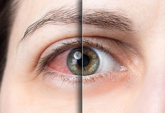 Ipl Treatment For Dry Eye Disease 