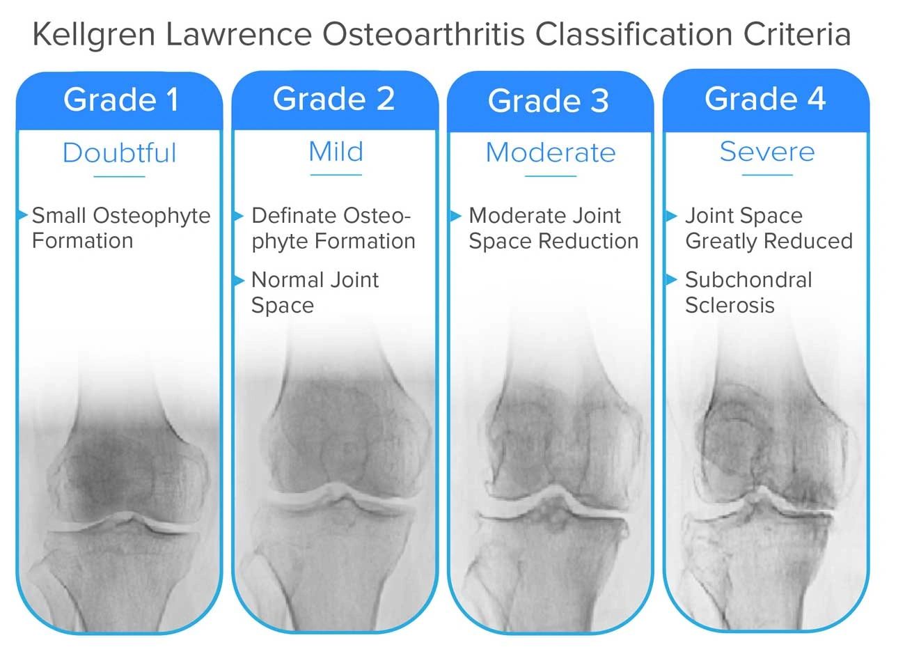 My Doctor Says I Have Mild Knee Osteoarthritis