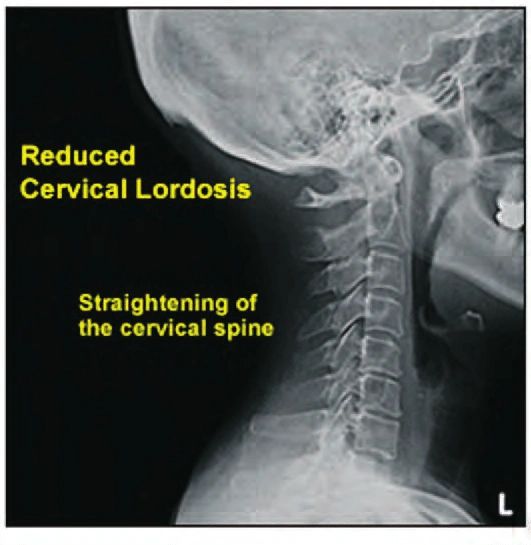 normal cervical lordosis