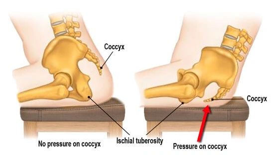 Coccydynia, Tailbone Pain, Treatment, Coccydynia, Coccyx and more