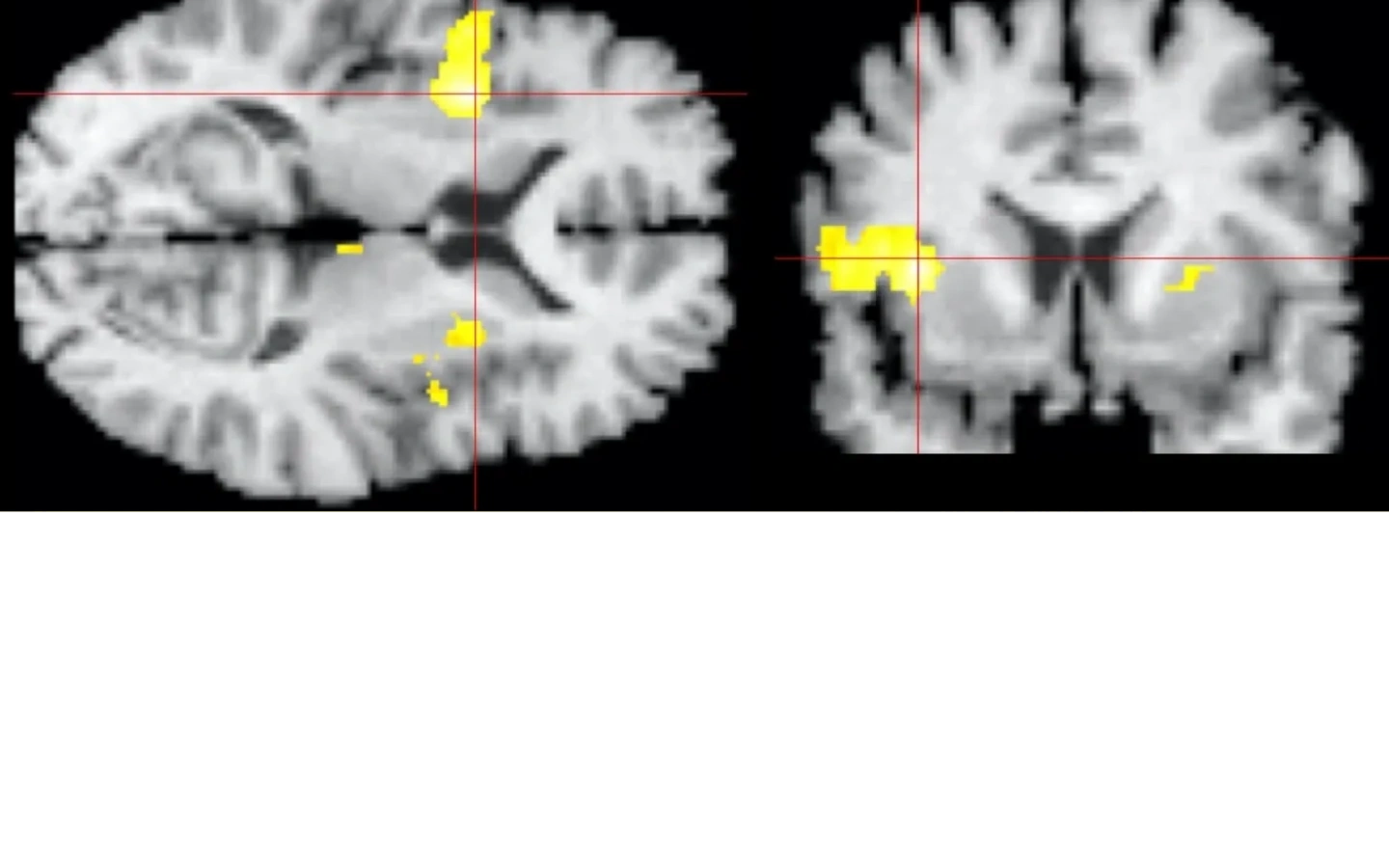 PET scan of Air Hunger showing activation of anterior insula