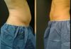 Nuestros pacientes Antes y después del coolsculpting 