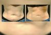 Nuestros pacientes Antes y después del coolsculpting 