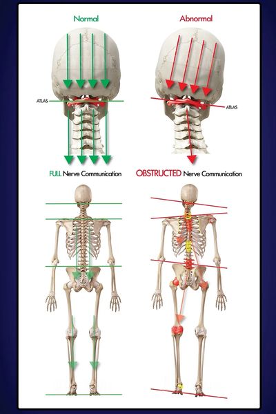 Misalignment of the spine