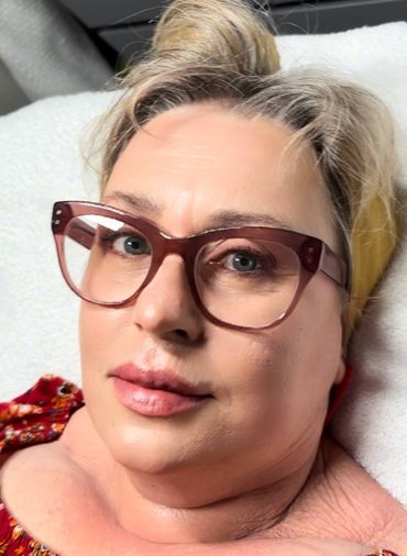 Dermal filler package to cheek, chin, jaw, nasolabial and marionettes. Botox to lip line and foreheas