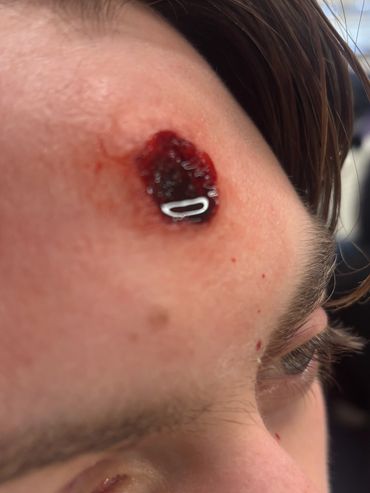Close-up of a forehead wound with blood and a foreign object embedded.