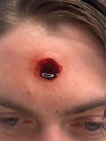 A fresh, bleeding wound on a person's forehead.