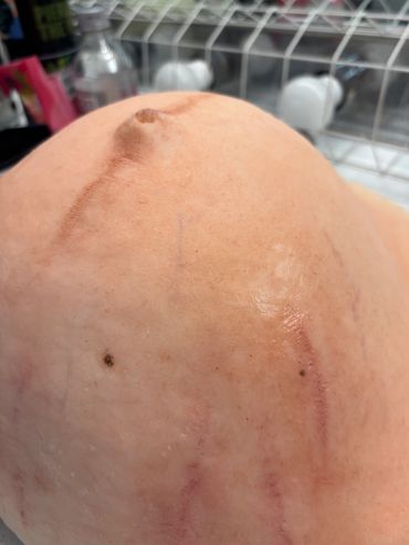 Close-up of a human breast showing scars and skin marks.