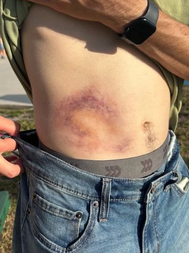 Large bruise on a man's side, revealed by lifting his shirt.
