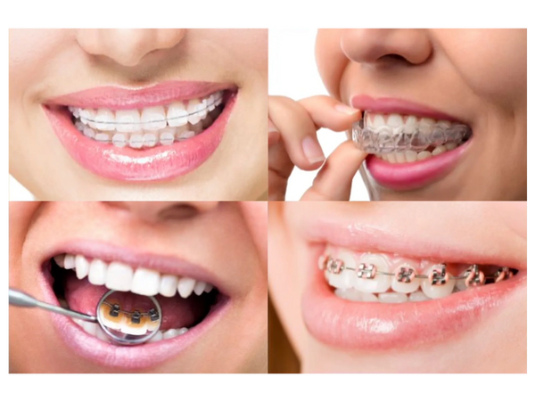 Invisalign Georgetown, ON, Invisalign® Braces Georgetown, ON