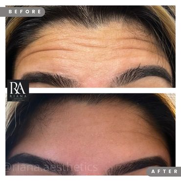 wrinkle, youthful
